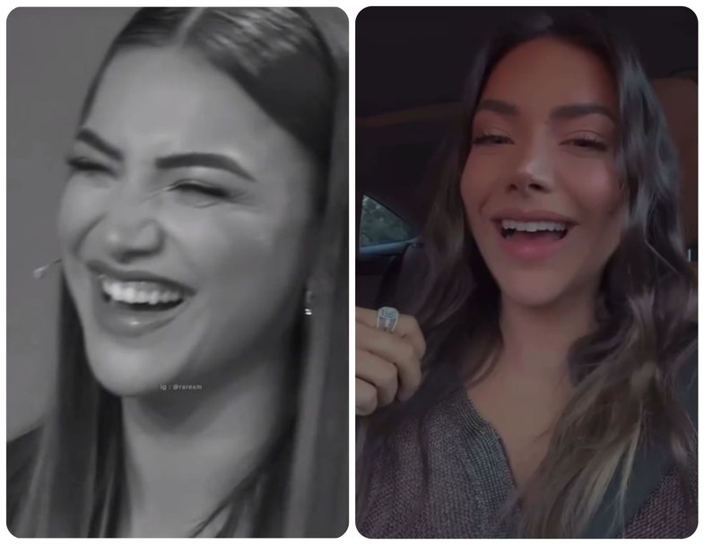 Buzëqeshja ‘gummy smile’ dhe ndërhyrja me botoks: